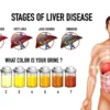 Liver disease