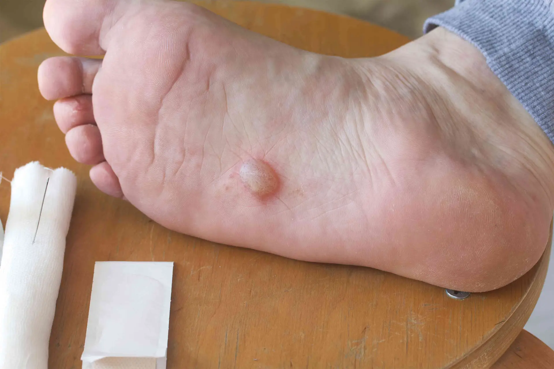 Foot Blister Treatment & Prevention | Causes, Care, and Expert Tips